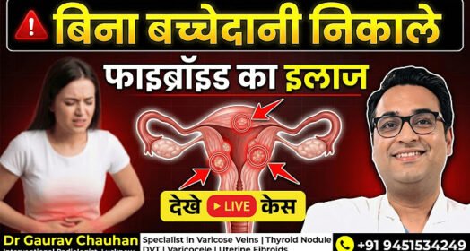 Uterine fibroids treatment without surgery