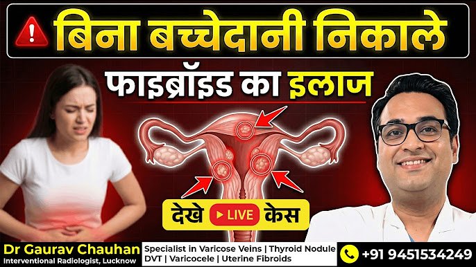 Uterine fibroids treatment without surgery