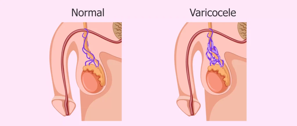 Normal Varicose vs Varicose