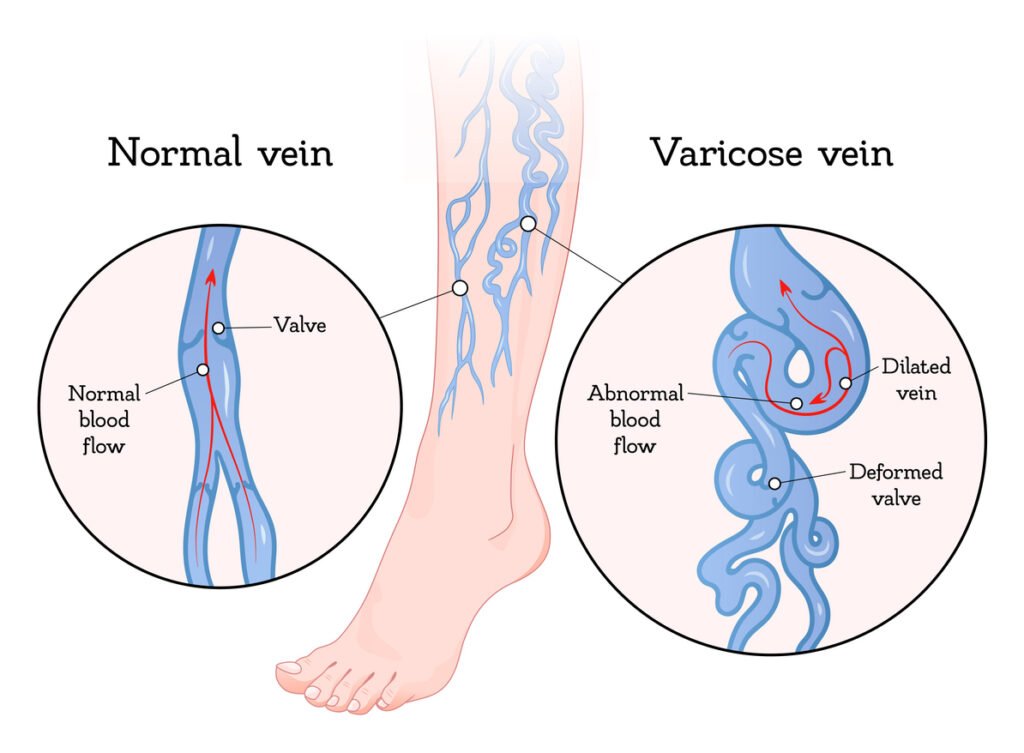 Normal Vein vs Varicose Vein