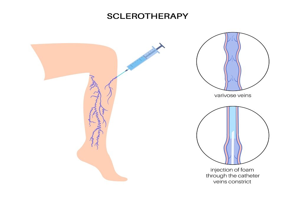 Sclerotherapy