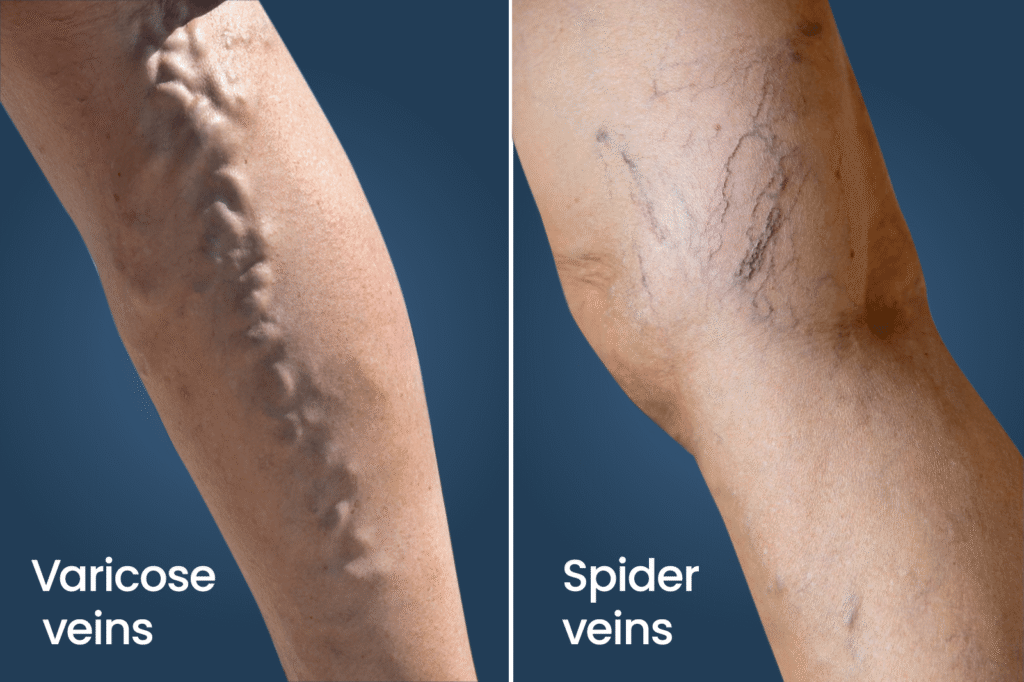 Spider Veins vs Varicose Veins