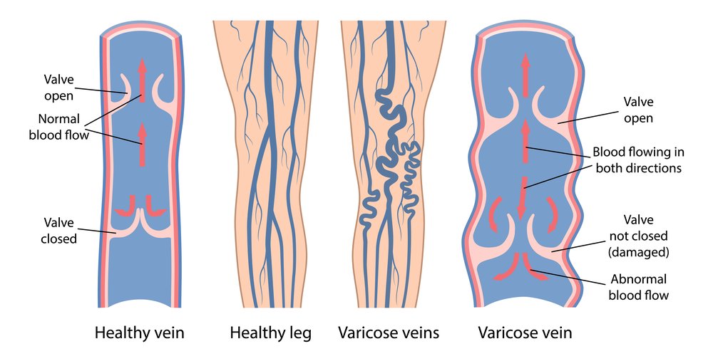 Varicose Veins में खून का उलटा बहाव