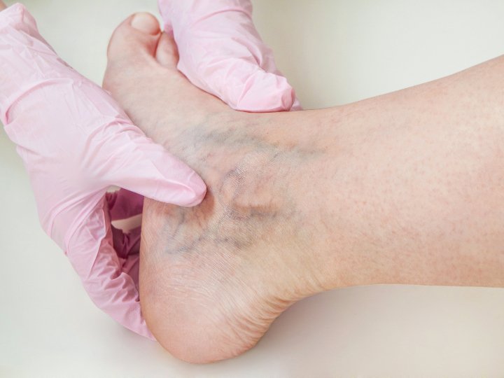Varicose Veins