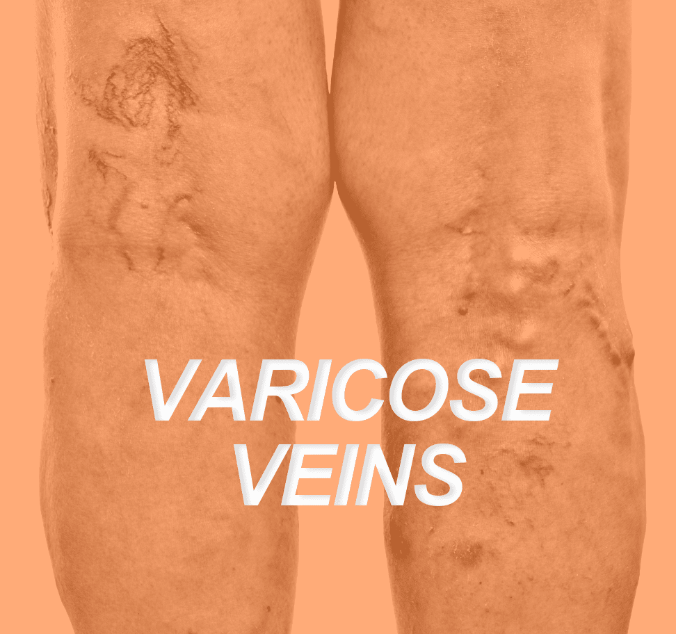 Varicose Veins