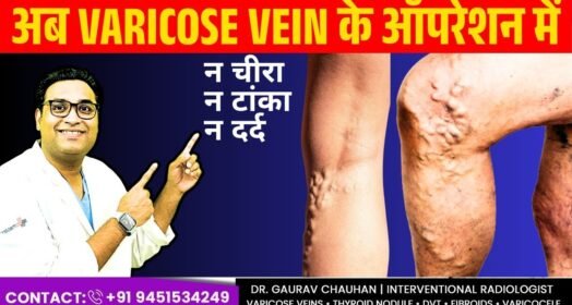 वो नीली नसें जो आपकी टांगों में उभर आई हैं वो सिर्फ दिखने की नहीं, महसूस करने की बात है।