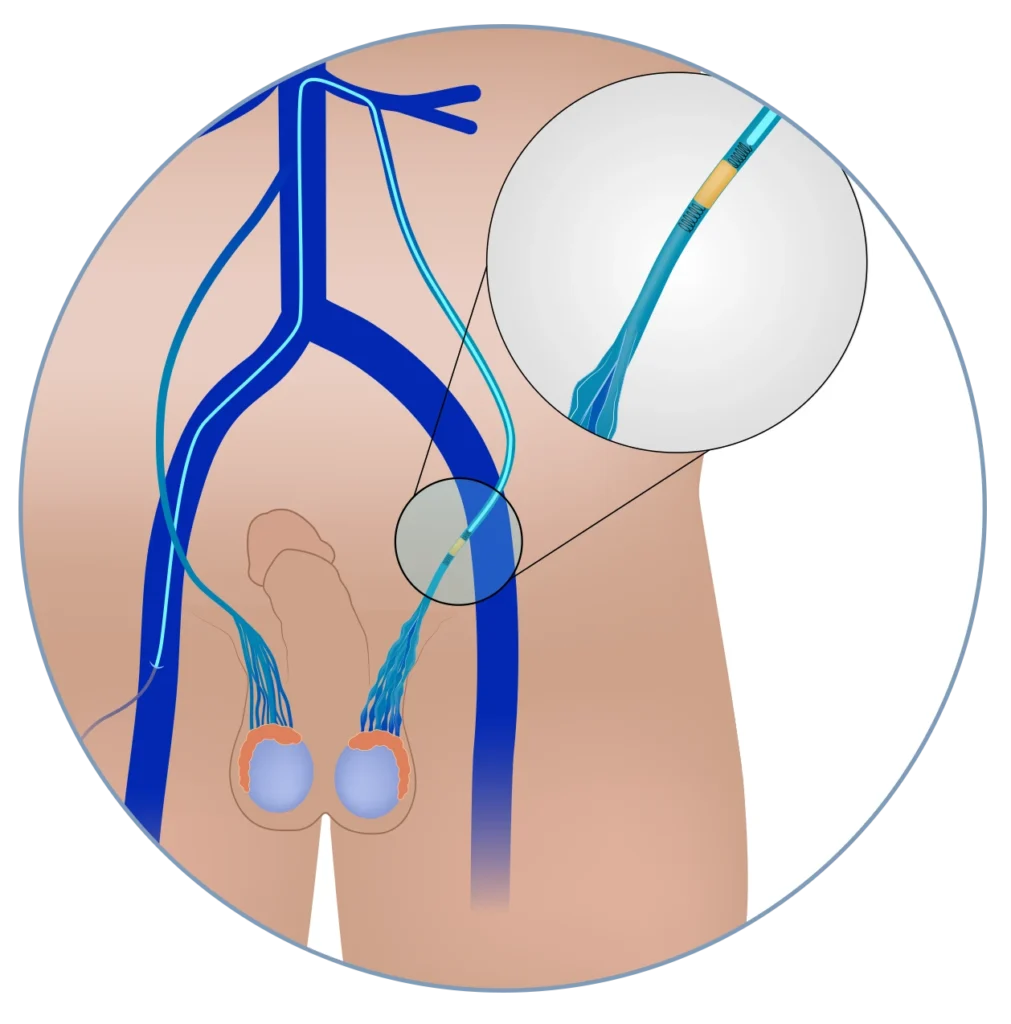 Varicocele Embolization