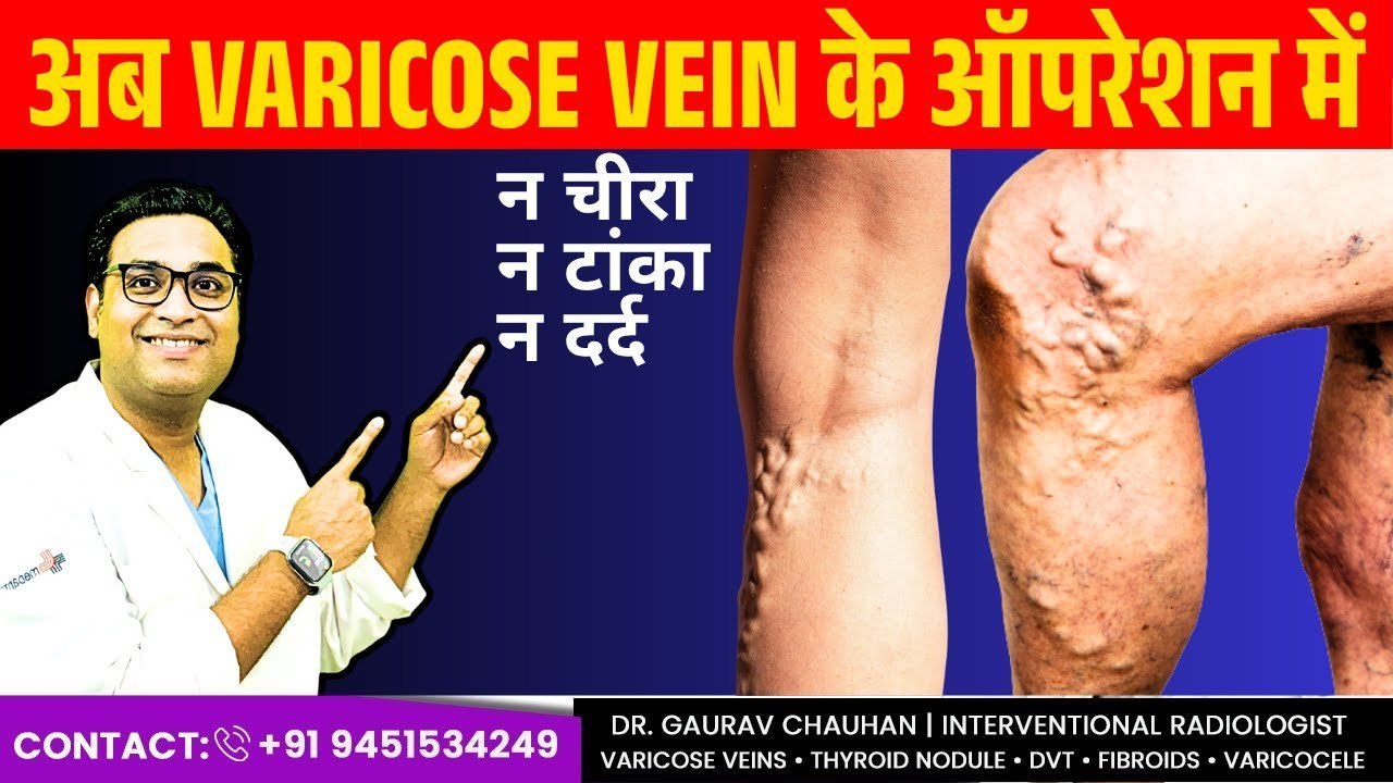 Best Varicose Veins Treatment in Lucknow